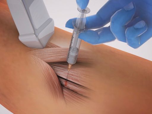Ultrasound guided tenocyte injection