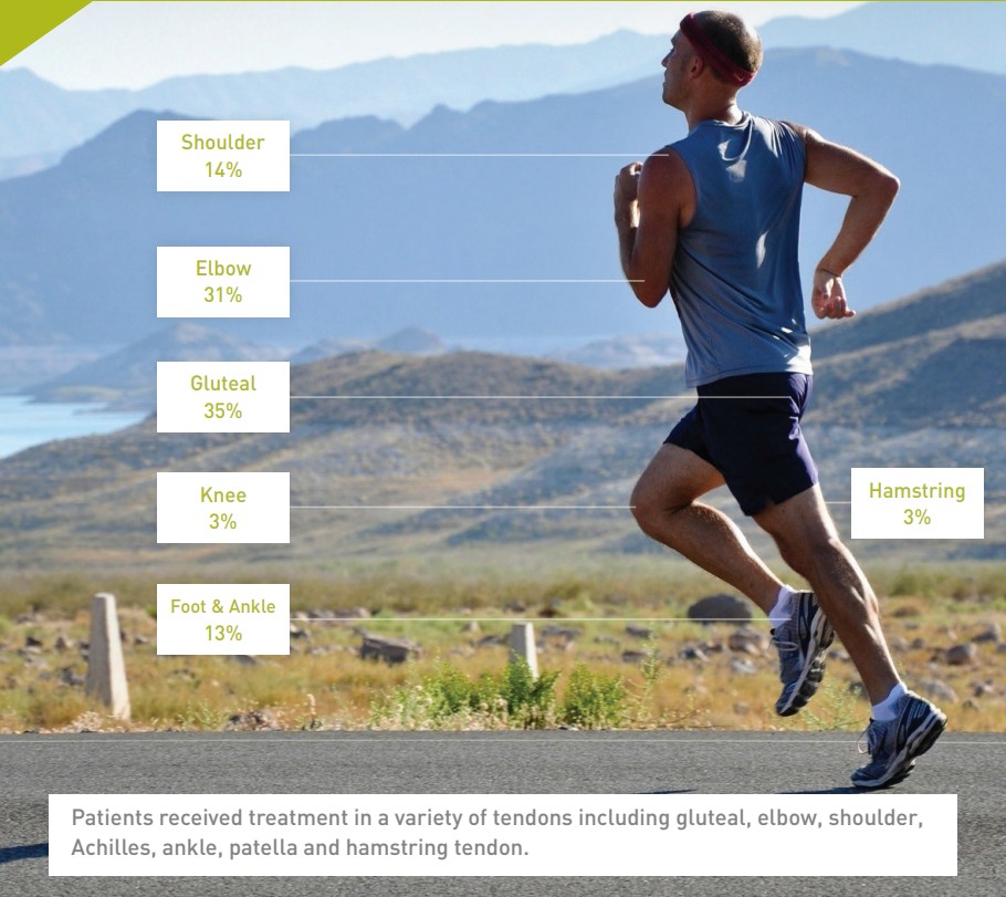 Clinical infographic showing tendon treatment locations on a running athlete including gluteal 35%, elbow 31%, shoulder 14%, foot and ankle 13%, knee 3% and hamstring 3%